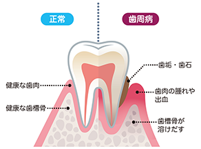 歯周病治療